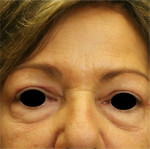Eyelid Surgery