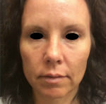 Restylane and Perlane