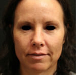 Restylane and Perlane