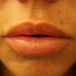 Lip Augmentation