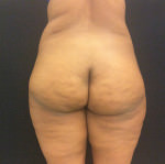 Fat Transfer - Gluteal