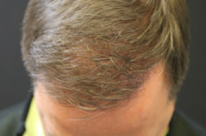 NeoGraft