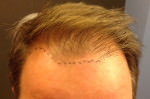 NeoGraft