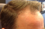 NeoGraft