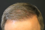 NeoGraft