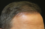 NeoGraft