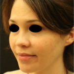 Restylane and Perlane