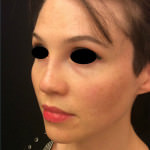 Restylane and Perlane