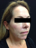 Sculptra