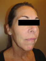 Sculptra