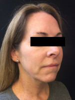 Sculptra