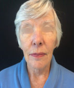 Neck Lift