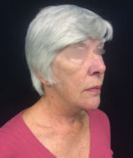 Neck Lift