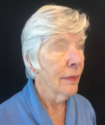 Neck Lift