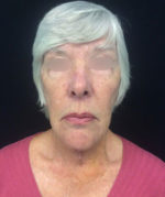 Neck Lift