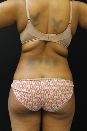 Liposuction