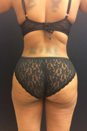 Liposuction
