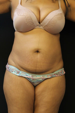 Liposuction