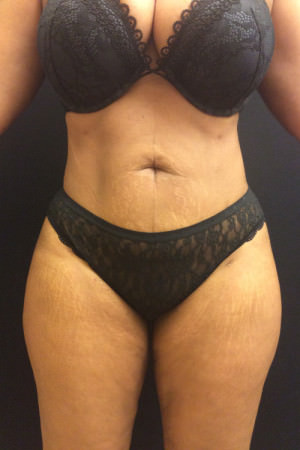 Liposuction