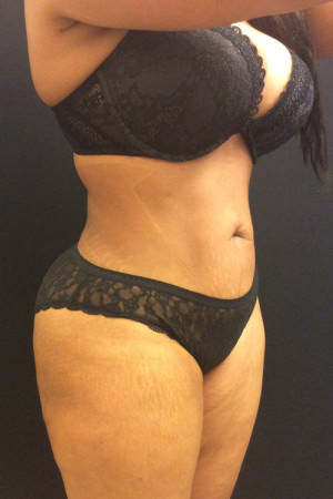 Liposuction