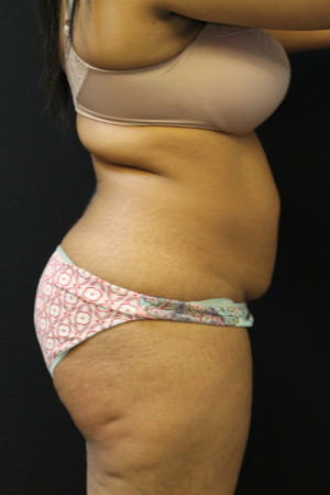Liposuction