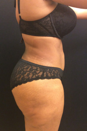 Liposuction