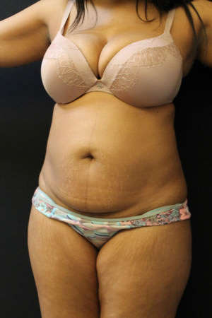 Liposuction