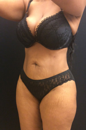 Liposuction