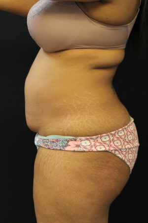 Liposuction