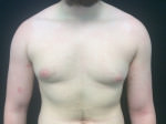 Gynecomastia