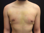 Gynecomastia