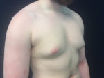 Gynecomastia