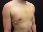 Gynecomastia