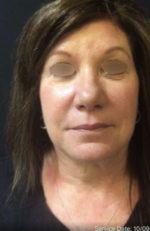 Restylane and Perlane