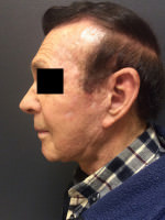Neck Lift