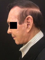Neck Lift