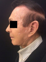 Neck Lift