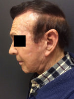 Neck Lift