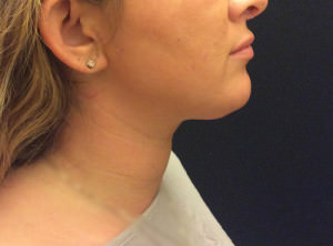 Liposuction Under Chin