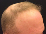 NeoGraft