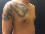 Gynecomastia