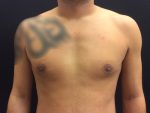Gynecomastia