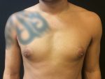 Gynecomastia