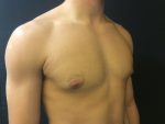 Gynecomastia