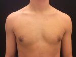 Gynecomastia