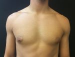 Gynecomastia