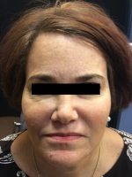 Botox Cosmetic and Dysport