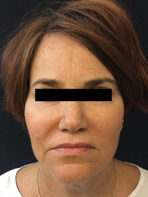 Botox Cosmetic and Dysport