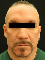 Botox Cosmetic and Dysport