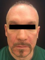 Botox Cosmetic and Dysport